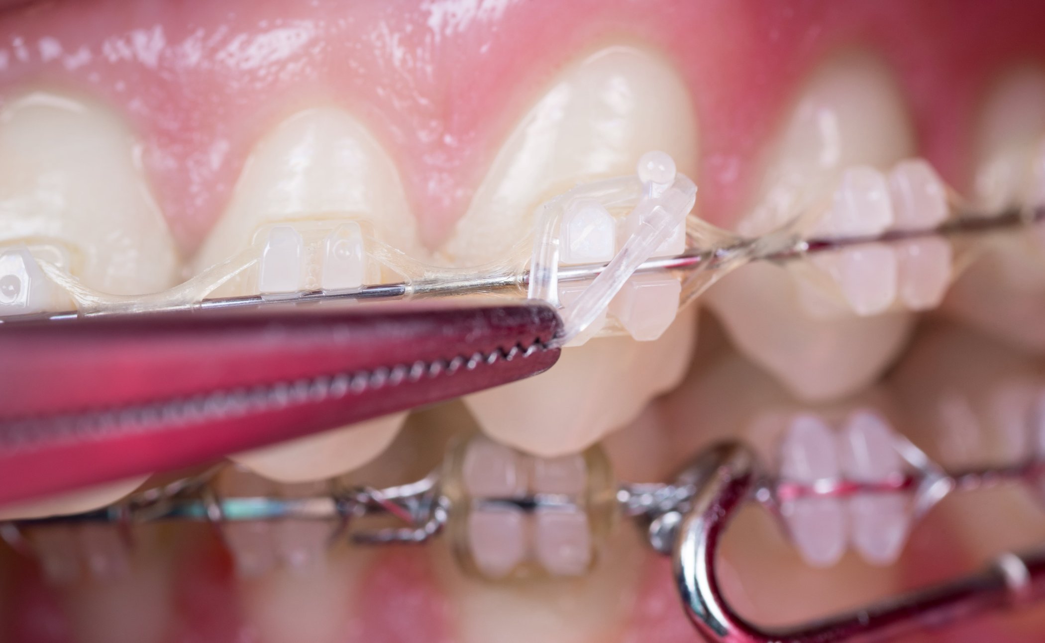 Brackets de autoligado vs convencionales